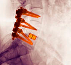 Artrodesis/fusión vertebral. 17 artrodesis-vertebral-o-fusion-vertebral-1564949355-1564950805