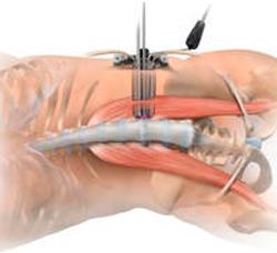 Artrodesis/fusión vertebral. 19 artrodesis-vertebral-o-fusion-vertebral-1564949355-1564950904