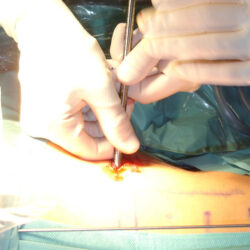 dsc07831.1536766854 - Lo que debe saber sobre la endoscopia percutánea de columna. Transforaminal vs. Interlaminar 