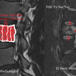 hemangioma 3 3.1556981498 - Hemangiomas vertebrales.