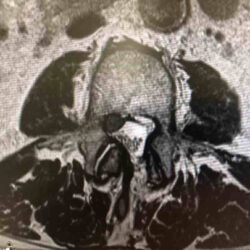hernia l2 l3 min.1574011110 - Por qué las hernias de disco se curan solas.