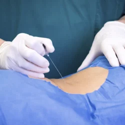 infiltraciones lumbares - Infiltraciones lumbares