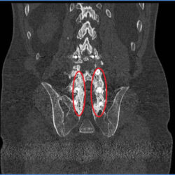 masa de fusion.1527617071 - Complicacion de la cirugía vertebral. Pseudoartrosis o falta de fusión vertebral.