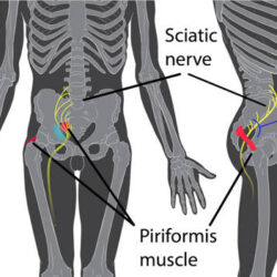 piriformis syndrome.1512484872 -  Síndrome del músculo piramidal
