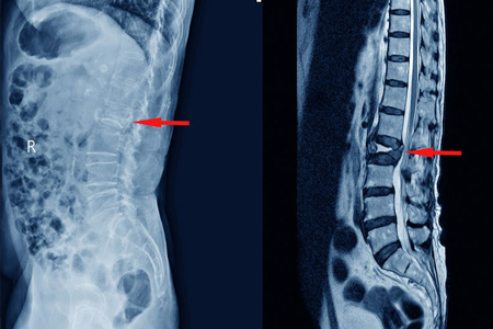 portada aplastamiento vertebral.1634098486 - Aplastamiento vertebral