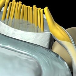 portada def.1686282269 - Estenosis de Canal: alivio efectivo para los problemas de compresión espinal