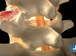 portada epidurolisis min.1578895317 - Epidurolisis. Una solución para la cirugía fallida de columna y la hernia discal.