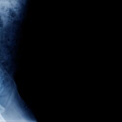 portada espondilosis min.1606107393 - Espondilosis. Que es, porque se produce y como puedes prevenir y tratar sus síntomas.