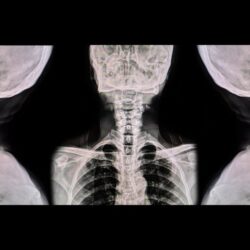 portada forestier rotes.1623297763 - Descubre la enfermedad de Forestier-Rotes.