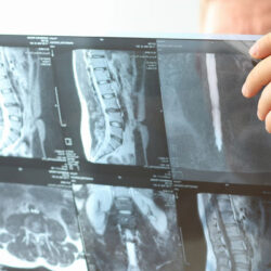 portada hernia de schmorl.1610947251 - Hernia de Schmorl