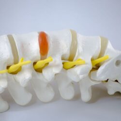portada hernia l3 l4.1648292348 - Todo lo que necesitas saber si tienes una hernia discal L3-L4