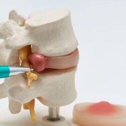 portada tipos d ehernia discal min.1592984373 - Tipos de hernia discal