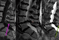resonancia enfermeda de baastrup.1571198557 - Enfermedad de Baastrup o Artrosis Interespinosa