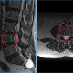 resonancia metastasis oseas.1620708847 - Metástasis vertebrales