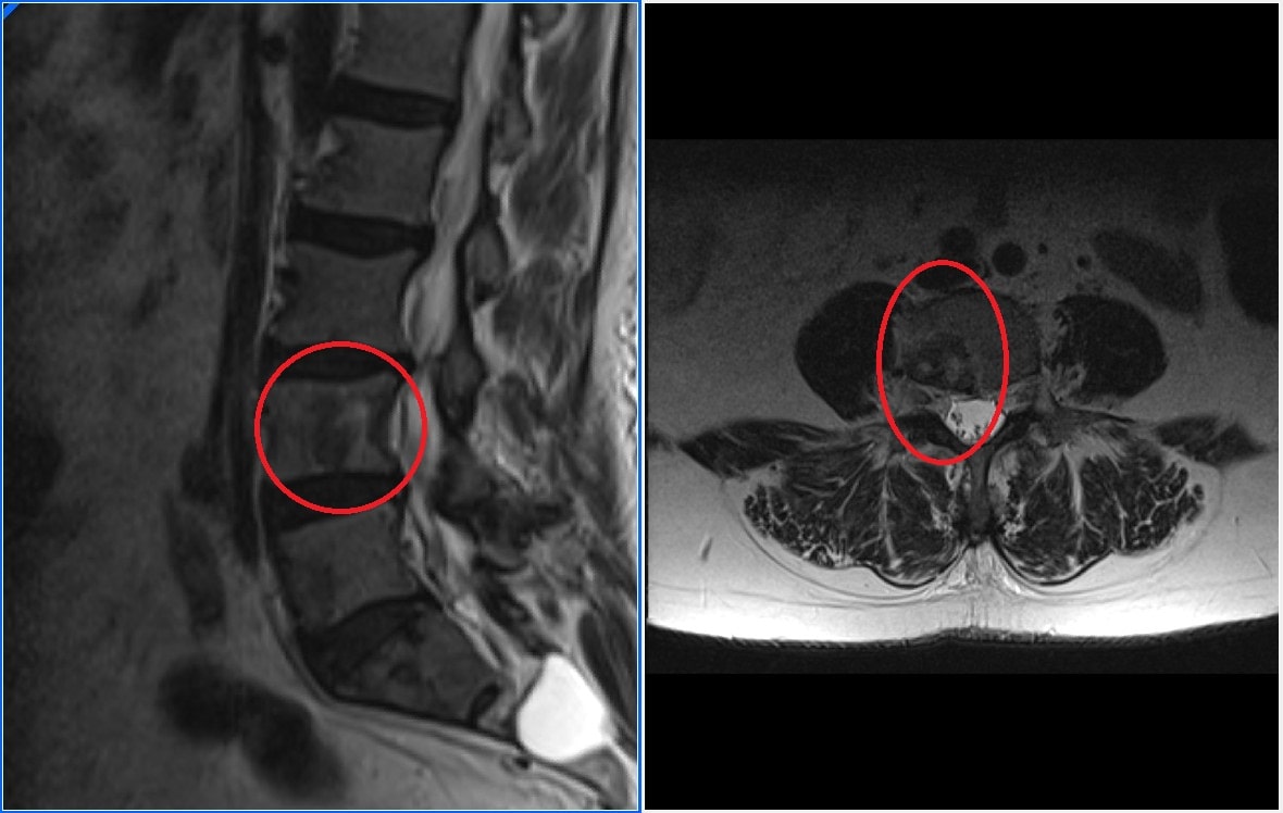 resonancia metastasis oseas.1620708847 - Metástasis vertebrales