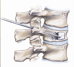 vertebroplastia - Aplastamiento vertebral