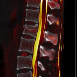 0 8.1601099571 - IMPORTANCIA DEL MECANISMO DE PRODUCCIÓN PARA EL DIAGNÓSTICO Y TRATAMIENTO DE LAS FRACTURAS VERTEBRALES