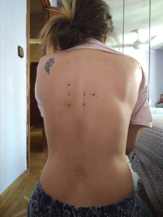 cirug&iacute;a de columna de Alicia