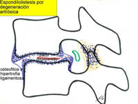ARTROSIS LUMBAR. Cómo evoluciona y por qué se producen los síntomas 4 espondilolistesis degnerativa
