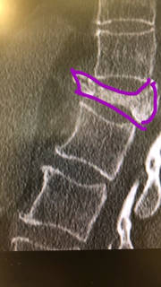 aplastamiento vertebral por osteoporosis