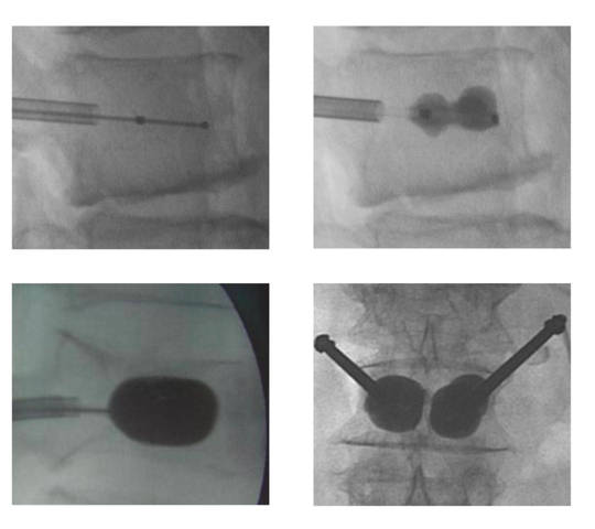 Qué es la cifoplastia con balón