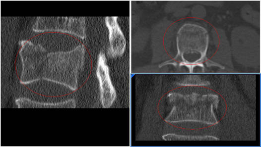 fractura osteoporotica en paciente con parkinson