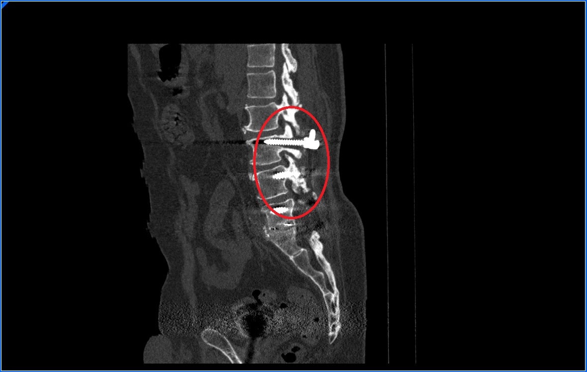 Cómo afecta la osteoporosis a la cirugía de raquis. 3 Complicaciones quirúrgicas por osteoporosis