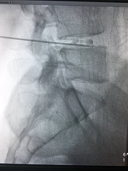 discogel indicaciones resultados y contraindicaciones 1575033762 1580705852 - DISCOGEL. Indicaciones, resultados y contraindicaciones