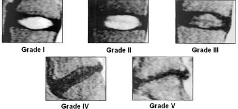 discogel indicaciones resultados y contraindicaciones 1575033762 1580706133 - DISCOGEL. Indicaciones, resultados y contraindicaciones