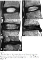 discolisis percutanea con laser tratasmiento percutaneo de los sintomas provocados por la hernia discal 1517238281 1526285714 - Tratamiento láser de los síntomas provocados por la hernia discal.