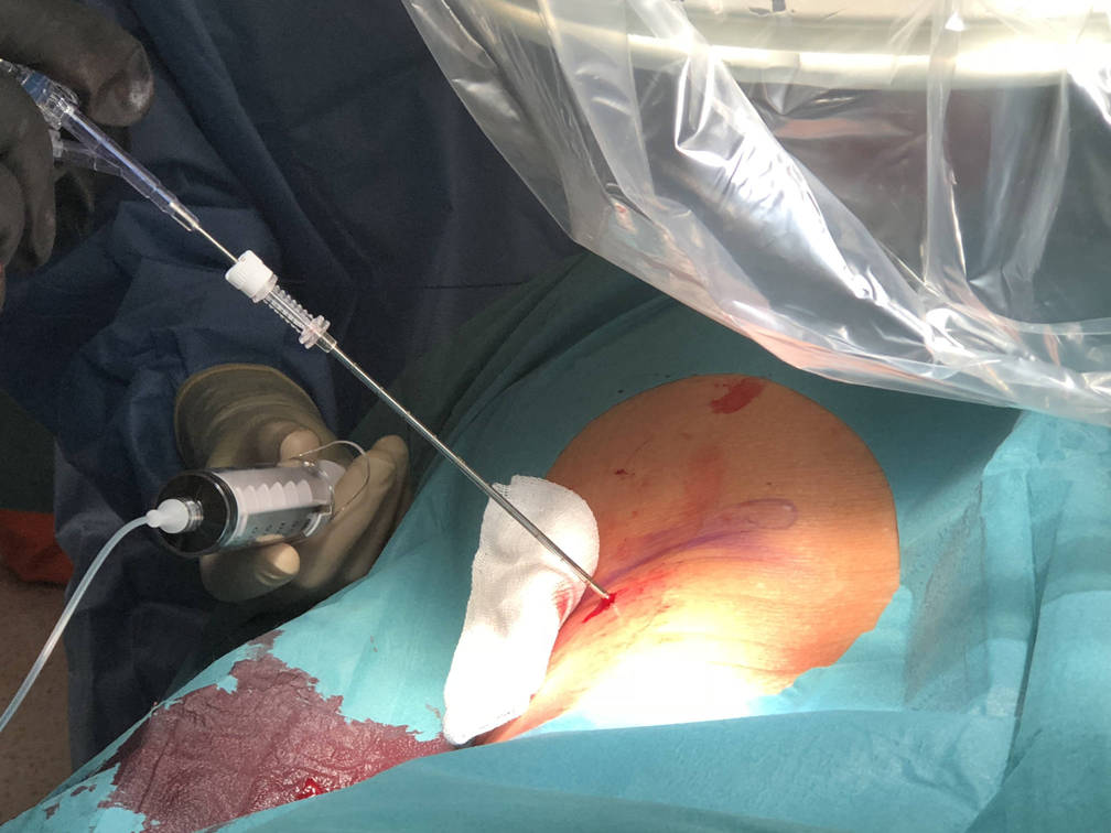 discolisis percutanea con laser tratasmiento percutaneo de los sintomas provocados por la hernia discal 1517238281 1526285778 - Tratamiento láser de los síntomas provocados por la hernia discal.