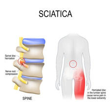 radiculopat&iacute;a