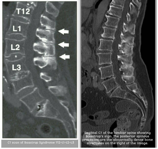 Enfermedad de Baastrup o Artrosis Interespinosa 4 Imagen TAC enfermedad de Baastrup