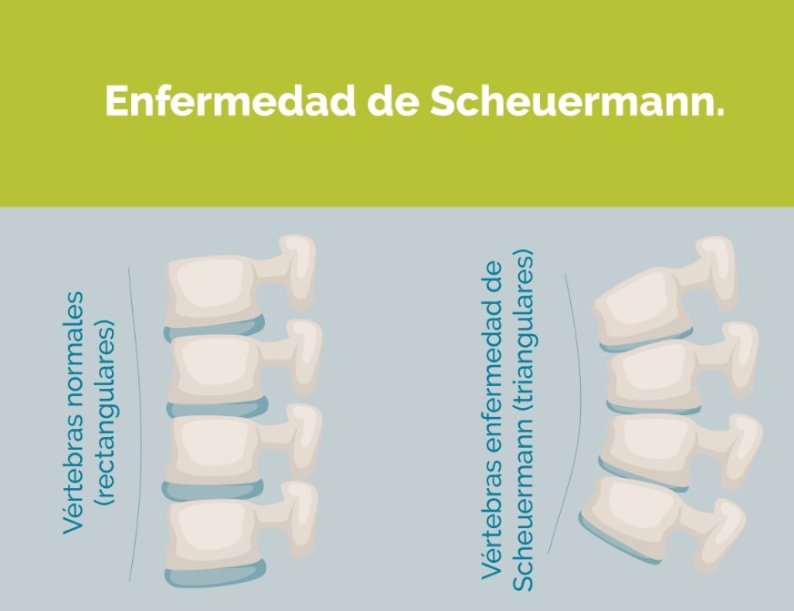 SCHEUERMANN vertebras acu&ntilde;adas