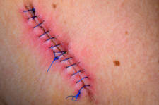 operaci&oacute;n hernia discal con infecci&oacute;n