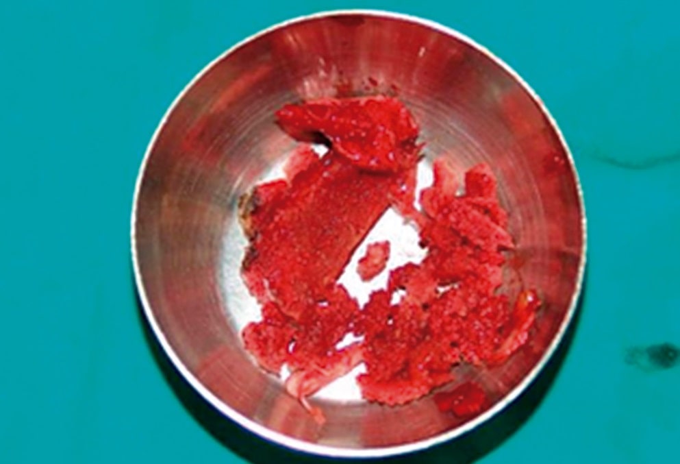 injerto aut&oacute;logo