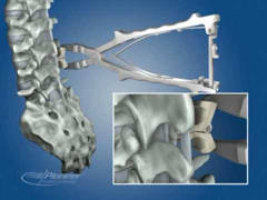 colocacion interespinosos bacjac