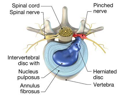 La importancia del nervio sinuvertebral en el dolor de espalda. 3 Nervio Sinuvertebral