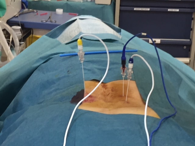 La importancia del nervio sinuvertebral en el dolor de espalda. 4 Nervio de Luschka