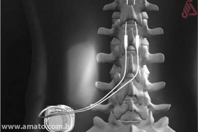 LUMBALGIA CRÓNICA 10 neuroestimulador para el dolor de espalda