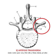 Mega apófisis transversa. Una causa poco conocida de dolor lumbar en personas jovénes. 2 síndrome bertolotti