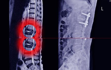 Metástasis vertebrales 4 Metástasis en Columna Vertebral