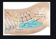 v&iacute;a abordaje olif