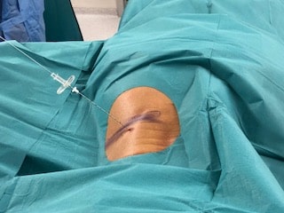 Que es el dolor discogénico 4 Tratamiento Dolor Discogénico