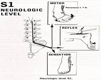 radiculopat&iacute;a S1