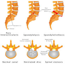 Espondilolistesis. Que es y como se alivian sus síntomas. 2 Espondilolistesis patológica