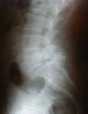 Espondilolistesis. Que es y como se alivian sus síntomas. 3 Espondilolistesis Lumbar