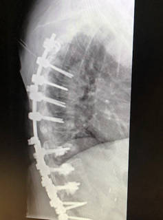 operaci&oacute;n degeneracion adyacente