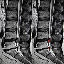 SÍNDROME POST-LAMINECTOMIA. Complicaciones de la cirugía de columna 4 recidiva hernia discal
