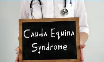 Sintomas de hernia discal graves. Cuando debes acudir a tu médico. 3 Síndrome de la Cola de Caballo
